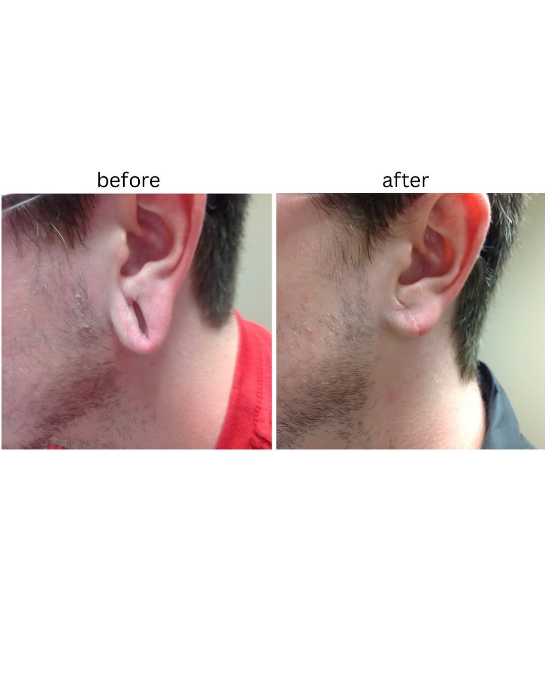 Instagram post by Dr. Evan Manolis: Small repair, big difference 👂✨ Earlobe repair can restore the shape of an earlobe that has been stretched, torn, or elongated from years o…