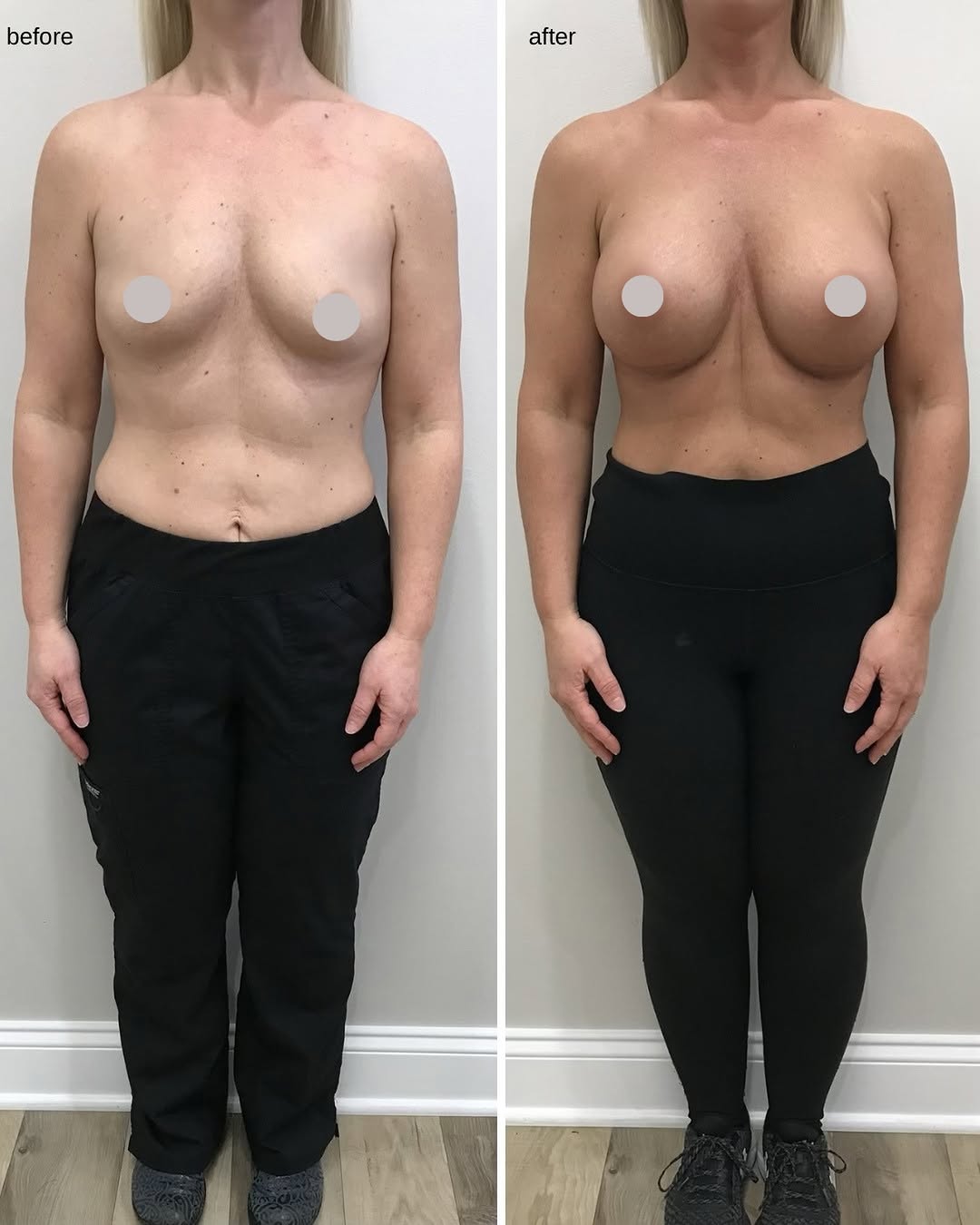 Instagram post by Dr. Evan Manolis: A little confidence boost 😍 Beautiful breast augmentation results with a natural, balanced look that complements her frame. Thinking about …