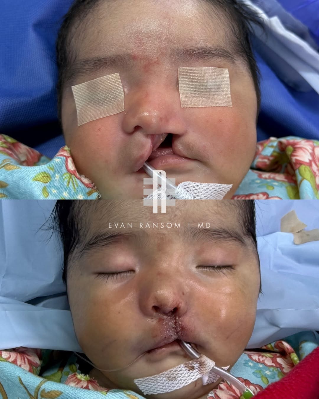 Instagram post by Dr. Evan Ransom: On his recent mission trip to Peru with Healing the Children, Dr. Ransom performed cleft lip and palate repairs on children who otherwise wo…
