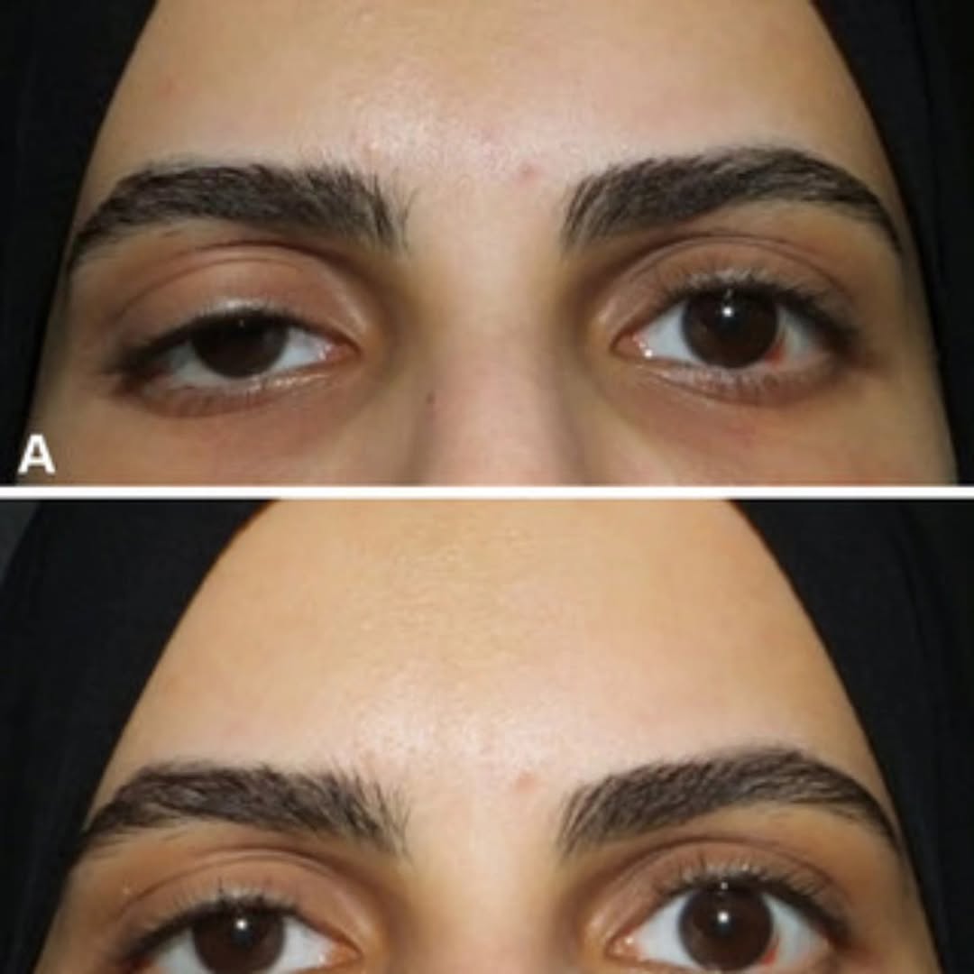 Instagram post by Dr. Evelyn Feng: Botox treatment for Droopy eyelids ??.......Ptosis of the eyelids can have various causes including congenital factors, medical conditions o…
