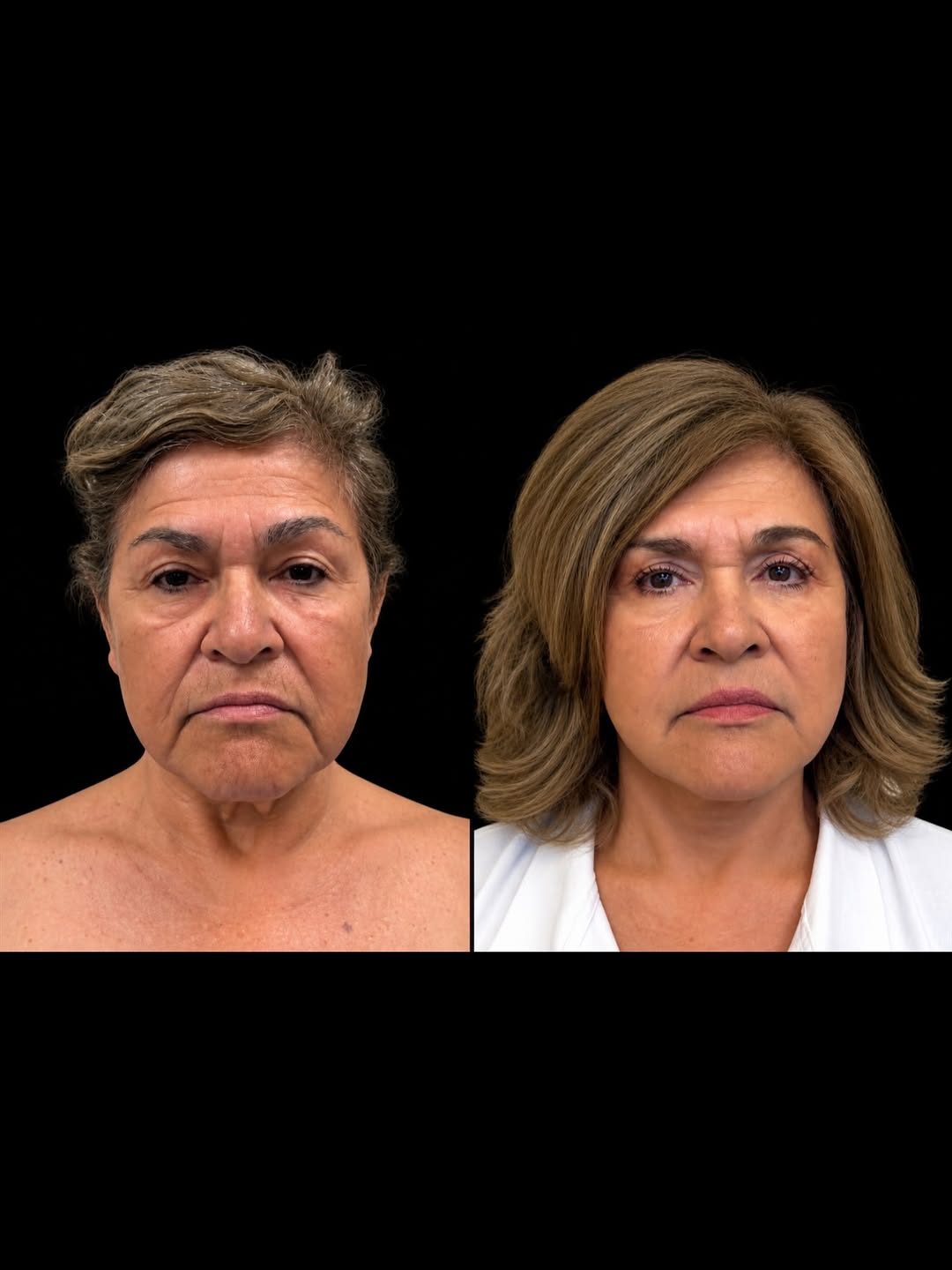 Instagram post by Dr. Fadi Chahin: 3 MONTHS POST-OP | FACELIFT Refined contours, improved definition, and a naturally refreshed appearance ✨ #facelift#beforeafter#transformati…