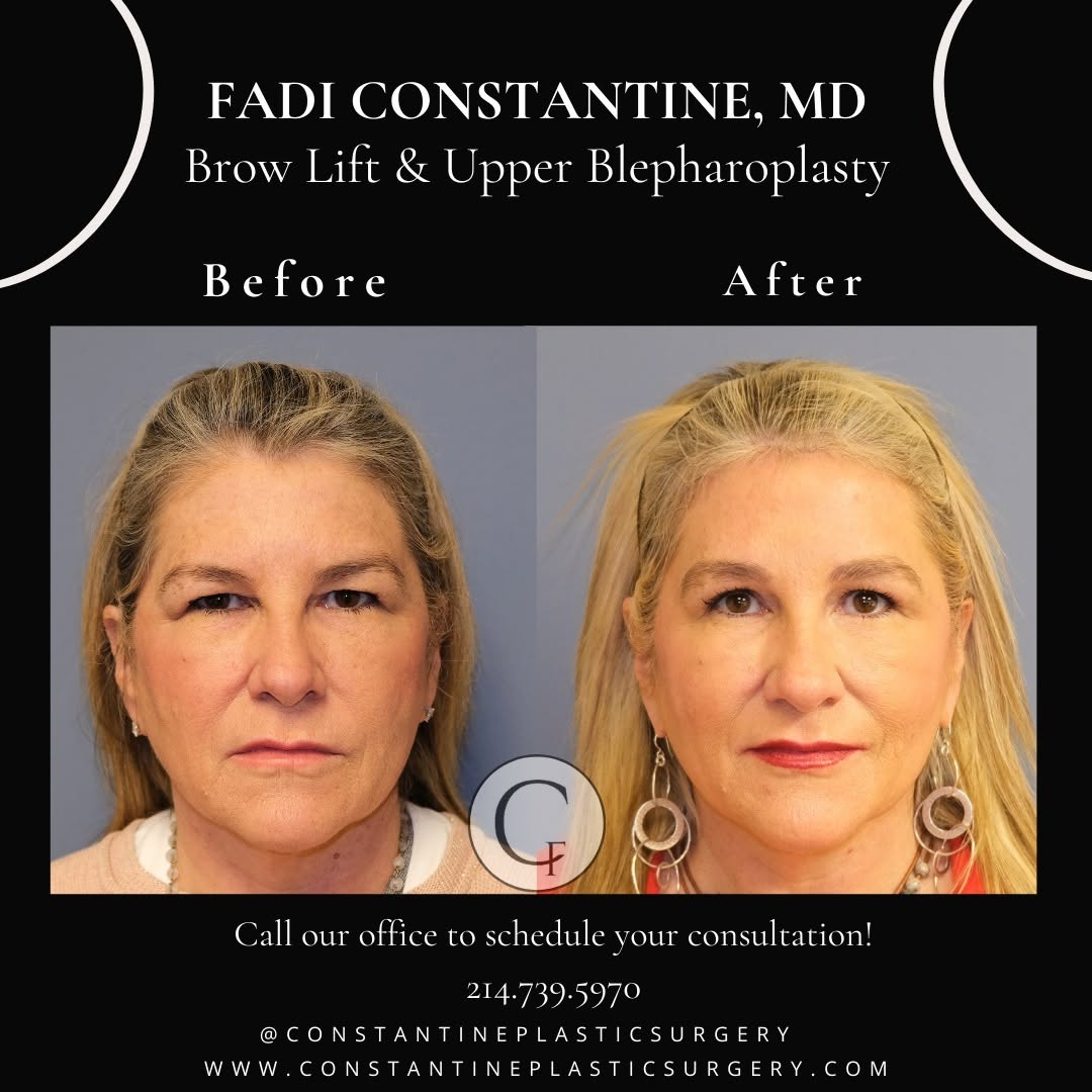 Instagram post by Dr. Fadi Constantine: Fear of an unnatural 'surprised look' is a common concern among patients considering the Brow Lift procedure. Dr. Constantine understands th…