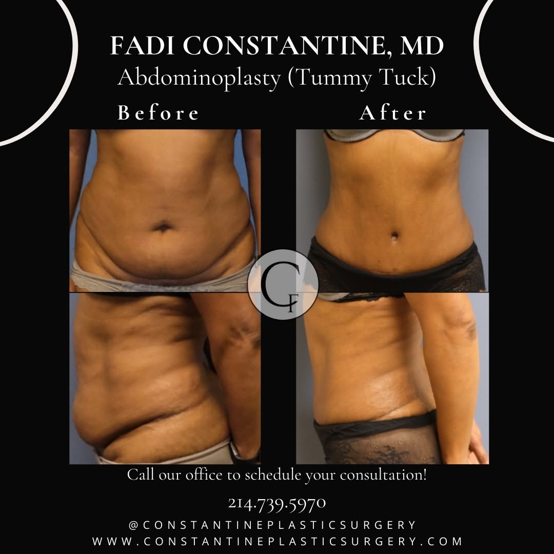 Instagram post by Dr. Fadi Constantine: What is an Abdominoplasty, commonly known as a tummy tuck? ✷ An Abdominoplasty is cosmetic surgical procedure aimed at removing excess skin …