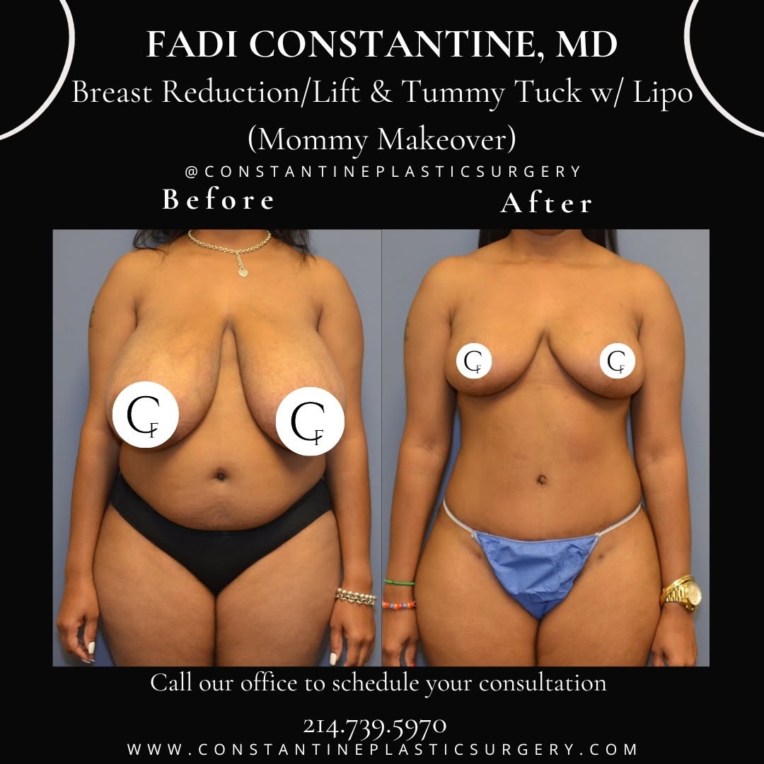 Instagram post by Dr. Fadi Constantine: After multiple pregnancies and breastfeeding, this beautiful patient came to Dr. Constantine for a full "mommy makeover" transformation, and…