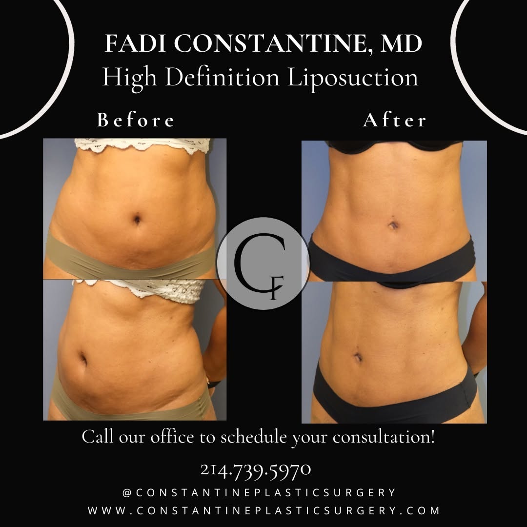 Instagram post by Dr. Fadi Constantine: High-Definition Liposuction at its finest! 💫 At 4 months Post-Op, our patient is absolutely loving her newly sculpted and toned abs 😍 In o…