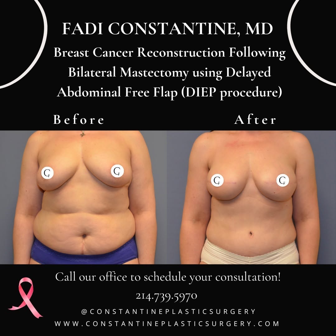 Instagram post by Dr. Fadi Constantine: The alternative to using breast implants for breast reconstruction is to use your own tissue. This involves transferring a flap of skin and …