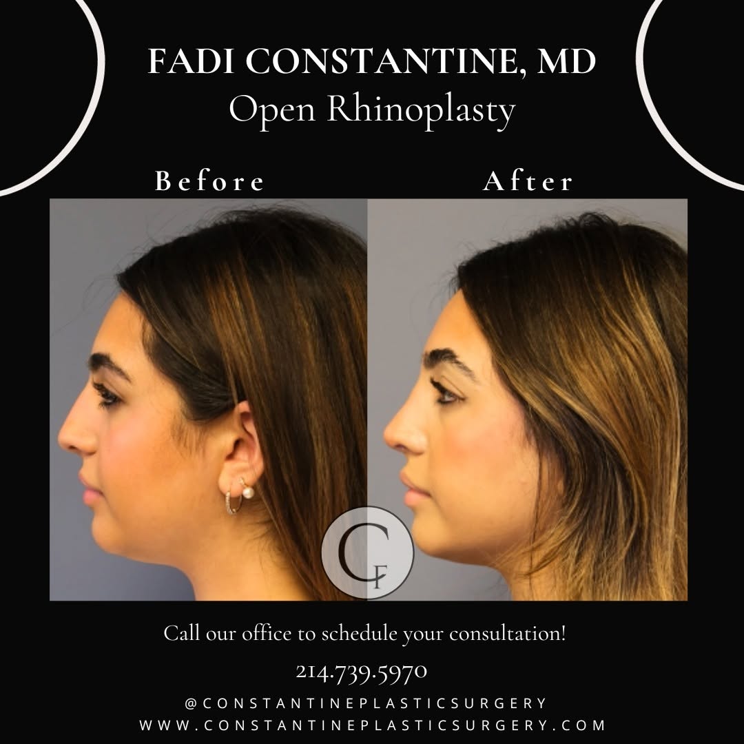Instagram post by Dr. Fadi Constantine: Dorsal hump be gone! ✨ Witness the stunning transformation of our patient's nose, where beauty meets improved function. At 3 months post ope…