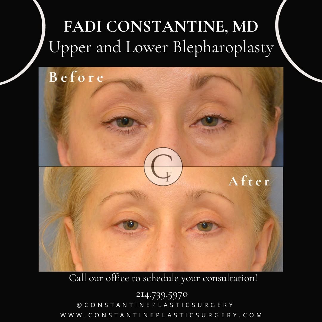 Instagram post by Dr. Fadi Constantine: ⏰ Day Light Savings Time may have given you an extra hour of sleep, but it won't do a thing for those stubborn under-eye bags or heavy upper…