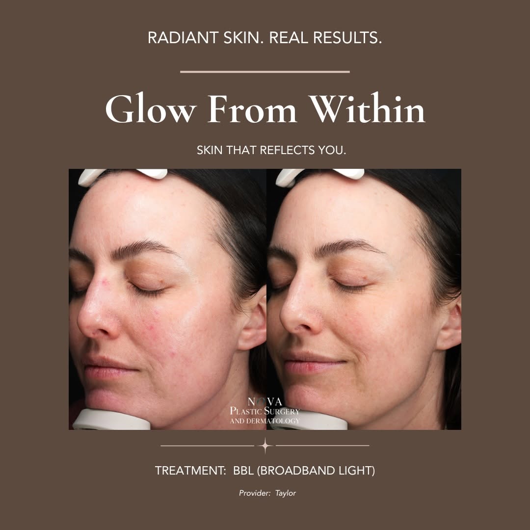 Instagram post by Dr. Fadi Nukta: Real skin, real results. BBL (BroadBand Light) is one of our go-to treatments for rosacea. Targeting redness and uneven tone with no downtim…