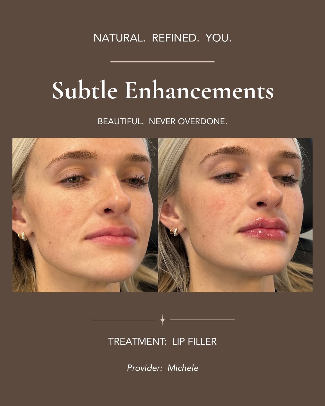 Instagram post by Dr. Fadi Nukta: Not every lip needs more volume. Sometimes it needs the right structure. This patient came in with a naturally M-shaped lip, hoping for more…