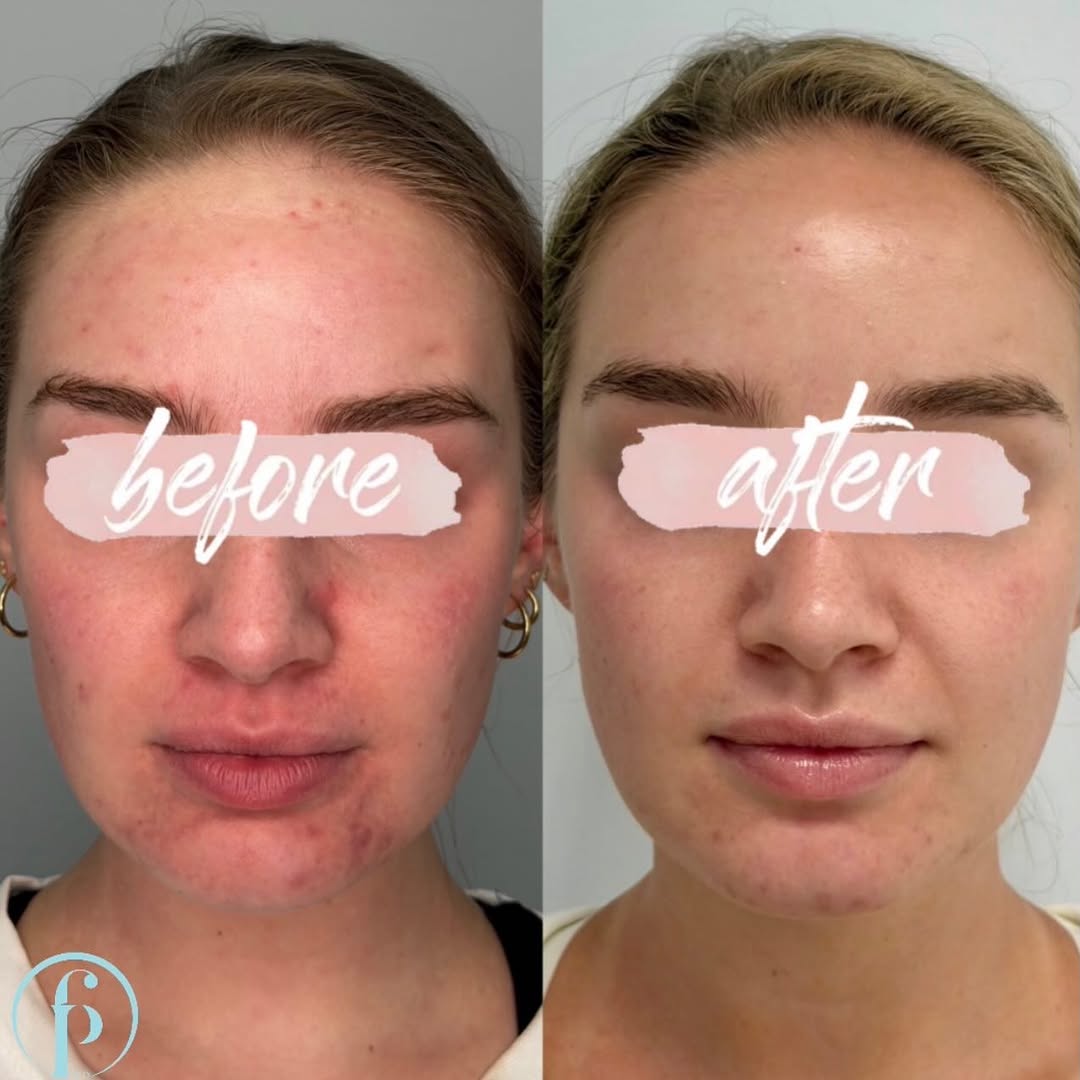 Instagram post by Dr. Falguni Patel: We don’t even know what to say anymore. The results speak for themself. Microneedling with PDRN is king 📲 732-444-4859 🧖 Stefanie LE 🪄 Sk…