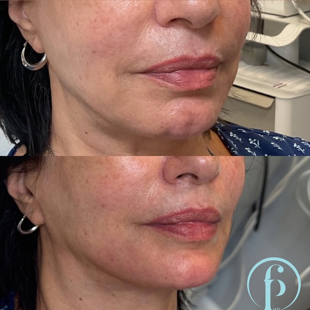 Instagram post by Dr. Falguni Patel: Chin + jawline ✨ Before & after with RHA® 4 subtle definition, enhanced balance, natural-looking results 💉 📲 732-444-4859