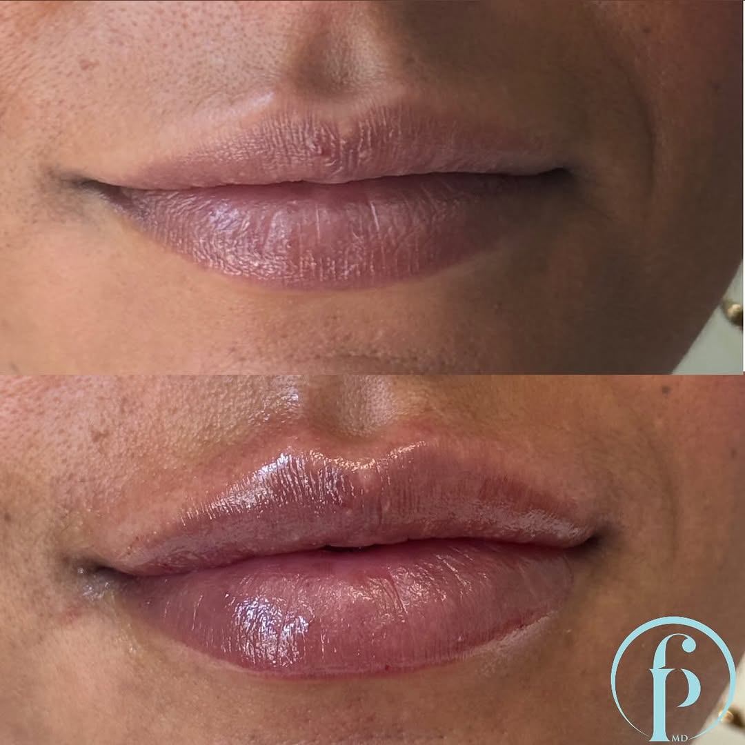 Instagram post by Dr. Falguni Patel: Enhancing natural lip shape and definition while adding a boost of hydration for soft, smooth, beautifully refreshed lips 💧💋 📲 732-444-48…