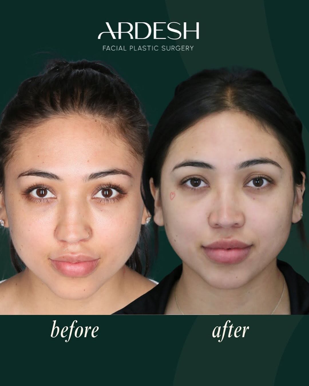 Instagram post by Dr. Farhad Ardesh: Doesn’t her nose look so cute? ✨ A subtle Septo-Rhinoplasty refined her nose while keeping it completely natural just enhancing what she alr…