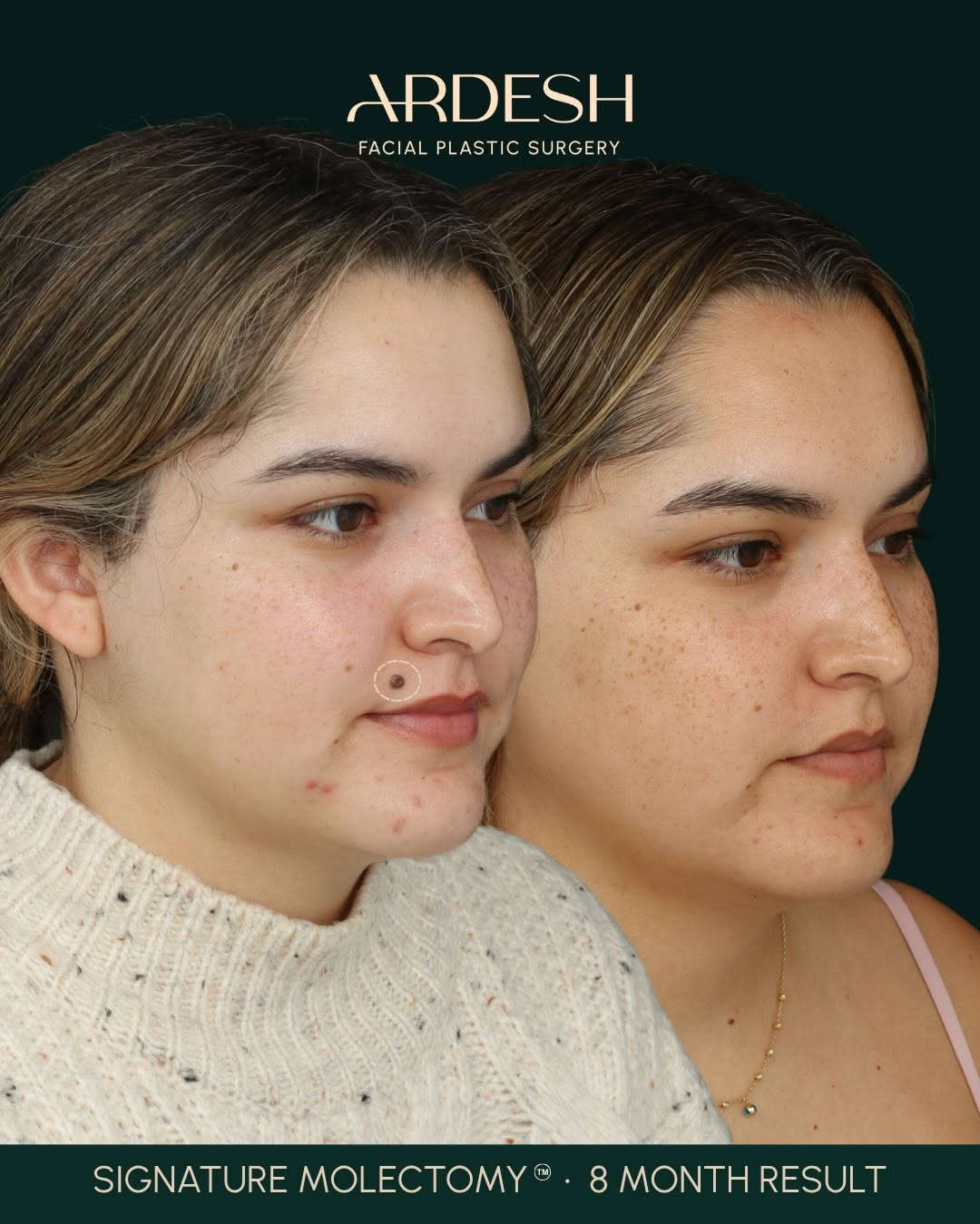 Instagram post by Dr. Farhad Ardesh: Upper lip mole removal, beautifully healed ✨ This 29-year-old patient wanted to remove a raised, dark-brown mole on her upper lip while pres…