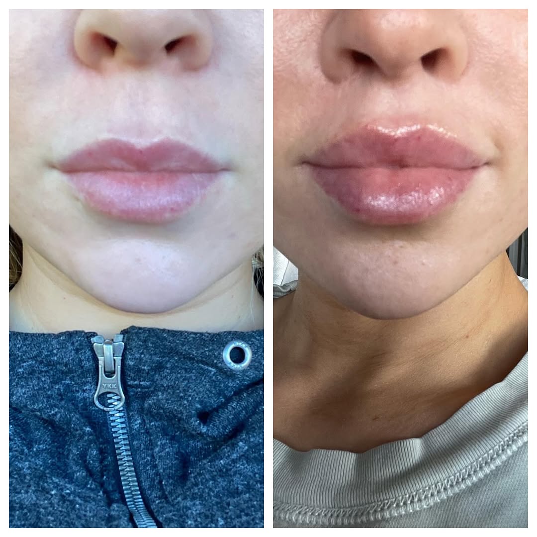 Instagram post by Dr. Farhad Rafizadeh: Before and after lip lift using my U-U-U incision. Lip to chin ratio improved to ideal. I did not do any lip augmentation. She loves her res…