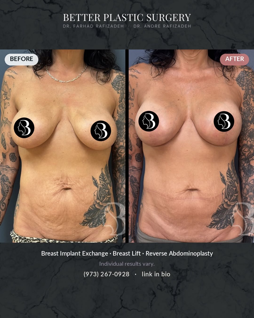 Instagram post by Dr. Farhad Rafizadeh: Breast implant exchange, breast lift, and a reverse abdominoplasty addressed together, in one thoughtfully planned procedure. Abdominoplasty…