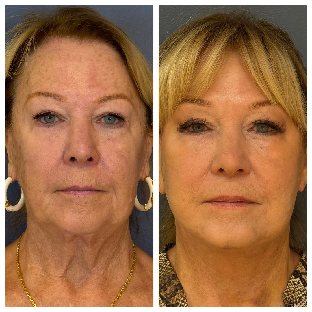 Instagram post by Dr. Farhad Rafizadeh: This patient came to me for results after having had a supposedly deep-plane facelift by an ENT in 2023. She had also had her left parotid r…