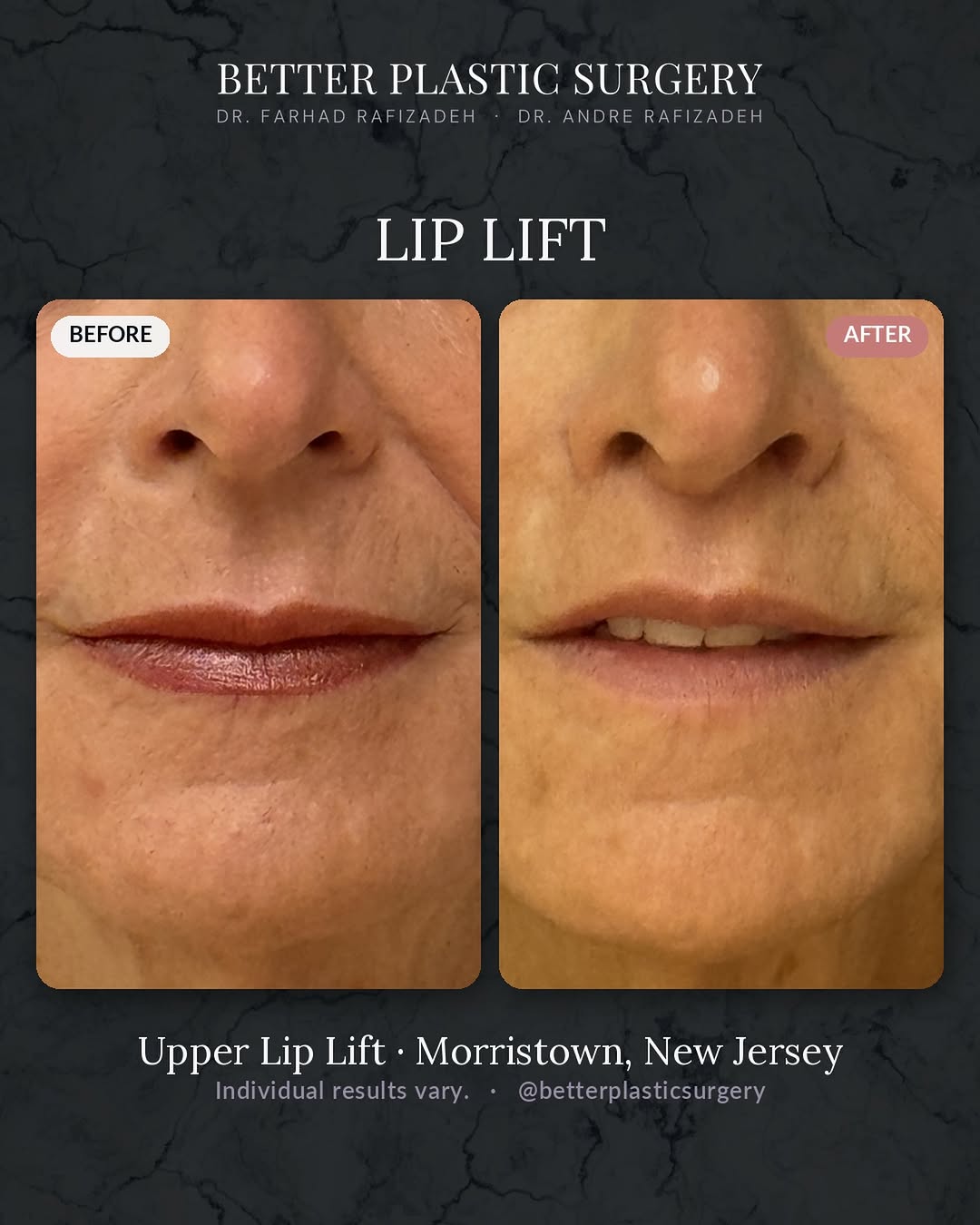 Instagram post by Dr. Farhad Rafizadeh: A lip lift doesn’t add volume — it shortens the space between the nose and lip so more of your natural upper lip shows, and the smile soften…
