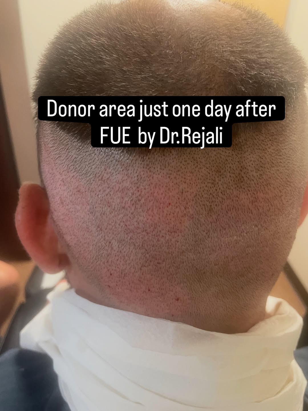 Instagram post by Dr. Farhad Rejali, N: Quick healing starts with a gentle technique. ✨ Just 1 day after shaven FUE, the donor area is already showing minimal redness and an impres…