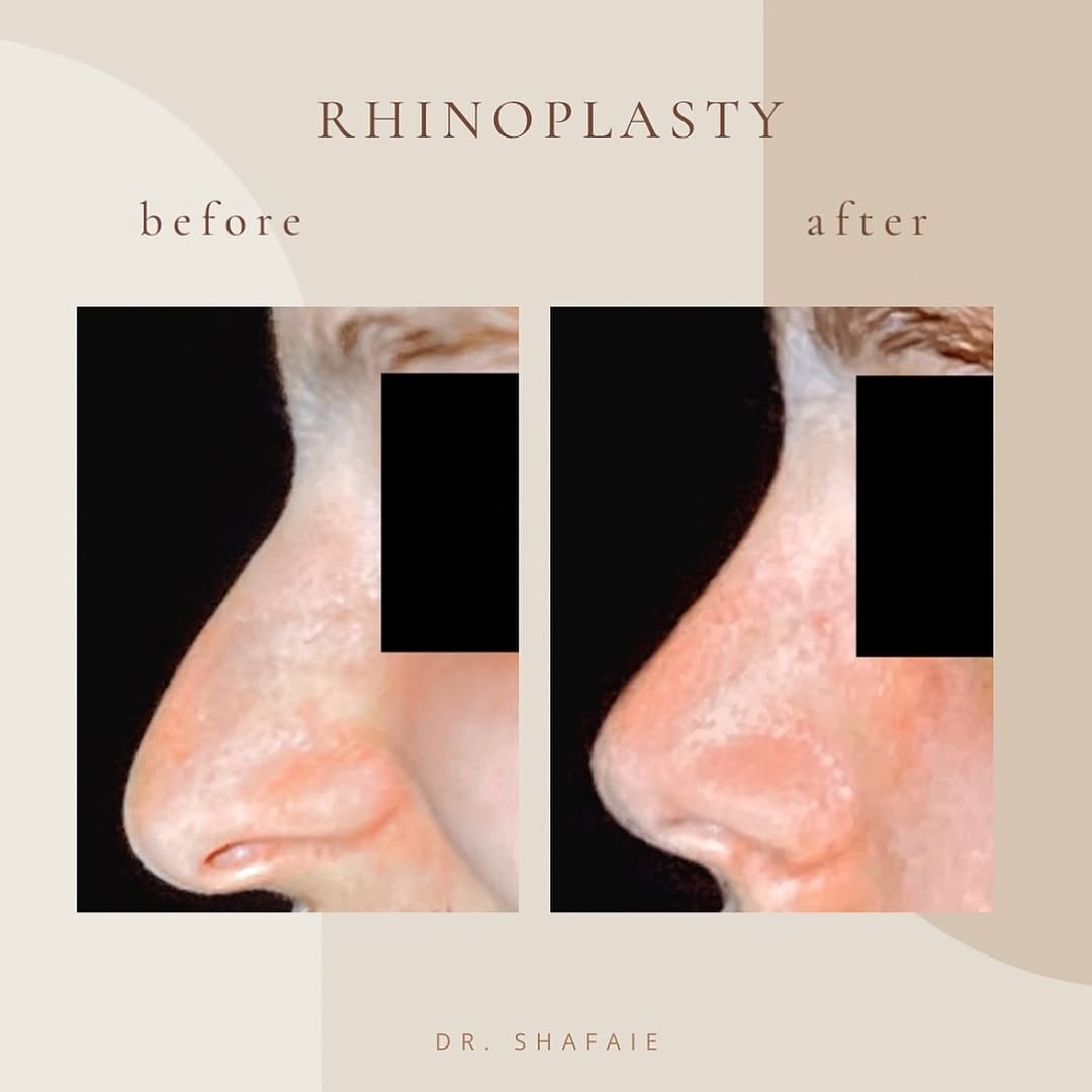 Instagram post by Dr. Farrokh Shafaie: Happy Tuesday, Instagram family ❤️ 👃✨ check out this amazing rhinoplasty transformation… are you considering a nose job? 🤔 Dr. Shafaie can…