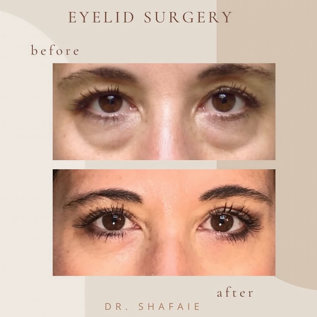 Instagram post by Dr. Farrokh Shafaie: WOW! 👀 Look at these stunningly natural results from Dr. Shafaie’s upper and lower blepharoplasty aka eyelid surgery ✨ Want a refreshed loo…