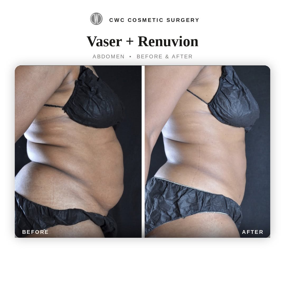 Instagram post by Dr. Fazil Mohamed: 🩵 Vaser and Renuvion on the Upper/Lower Abdomen to remove excess fat and tighten skin from underneath🩵 #skintightening #fatremoval #weight…