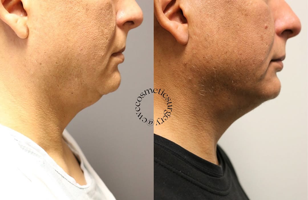 Instagram post by Dr. Fazil Mohamed: ✨Before and After #Vaser and #Renuvion on the Chin/Neck✨ 🩵Why wait to get chin definition when you can have instant results!🩵 ✨Schedule yo…