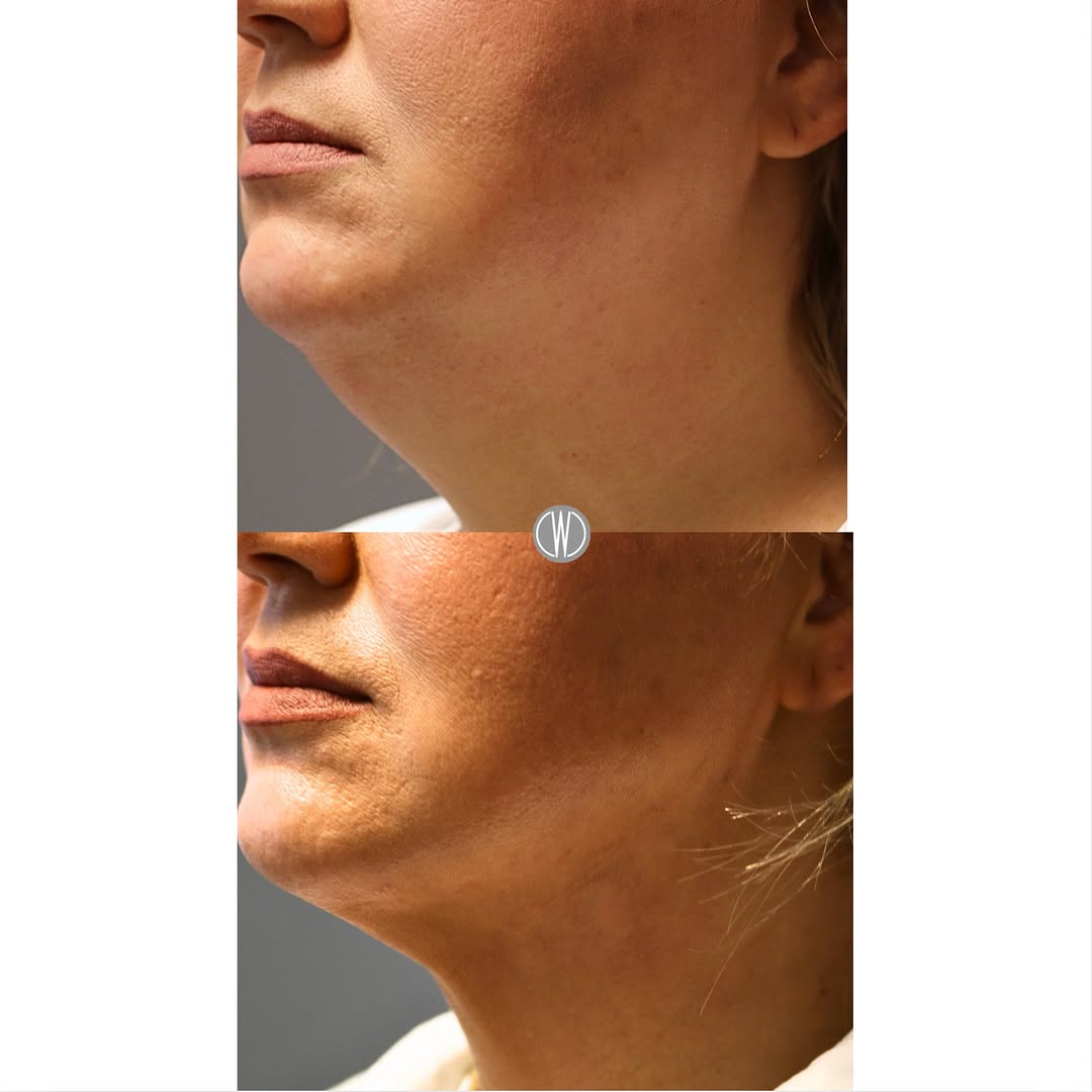 Instagram post by Dr. Fazil Mohamed: ✨🩵A sharper jawline, a lifted neck — VASER Liposuction + Renuvion J-Plasma contouring at its best.🩵✨ Results like these are why we love wh…