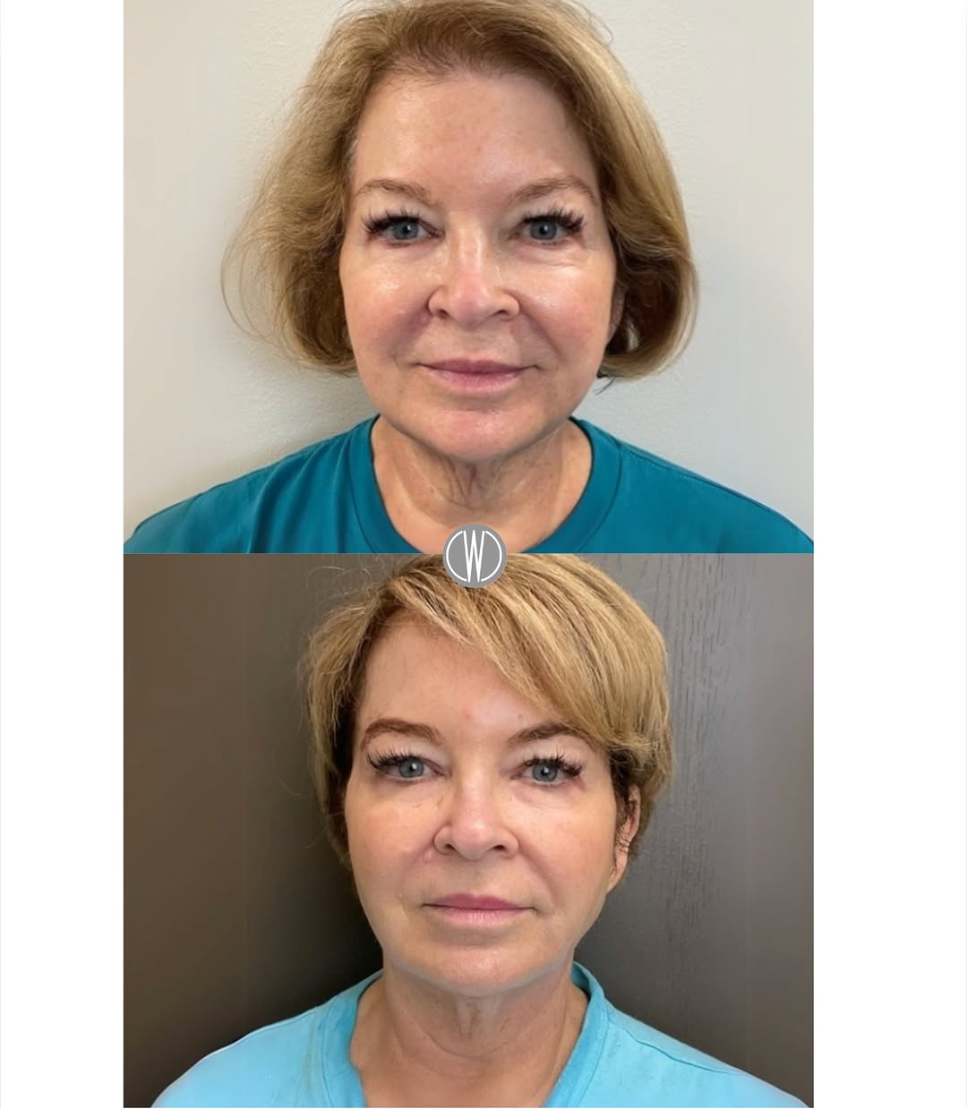 Instagram post by Dr. Fazil Mohamed: ✨Before and after Sofwave!✨ ✨This non-invasive treatment works wonders for lifting and smoothing, as seen in these before and after results.…