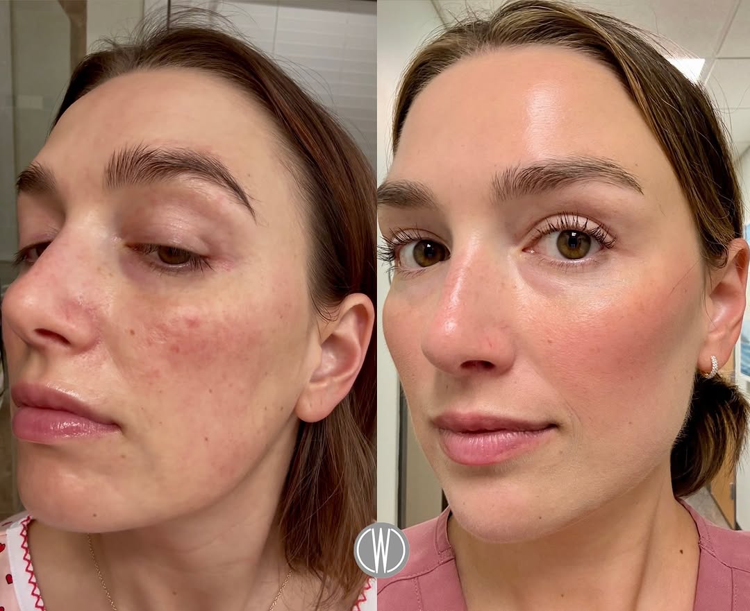 Instagram post by Dr. Fazil Mohamed: ✨ Before & After: 6 Months of P-TIOX + Neurotoxin + Retatrutide 🩵Six months of consistency can make a remarkable difference. 🧬 P-TIOX help…