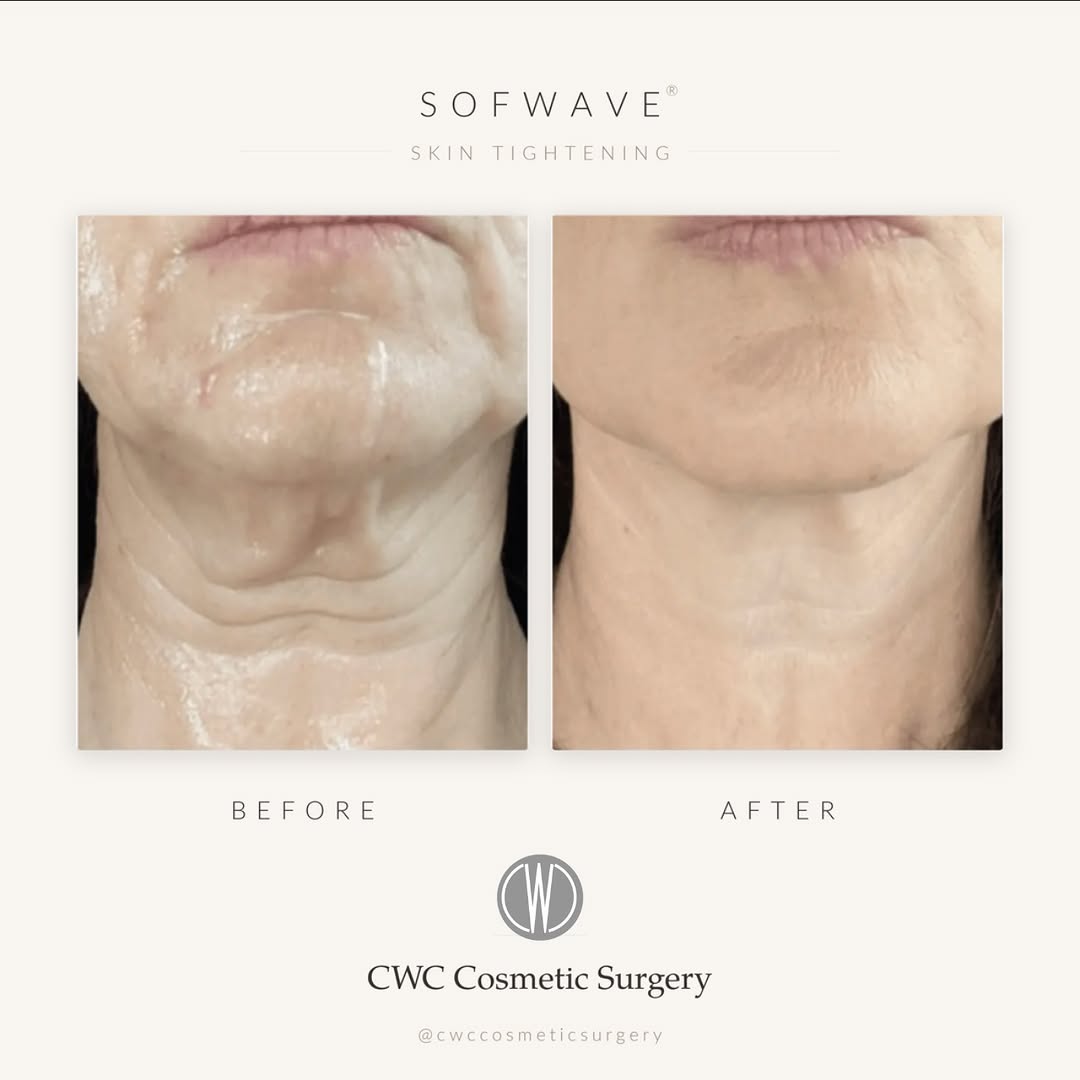 Instagram post by Dr. Fazil Mohamed: ✨Tighter skin. No surgery. No downtime.✨ 🩵This is a Sofwave® neck result — no incisions, no fillers, no recovery.🩵 ✨Sofwave uses SUPERB™ u…