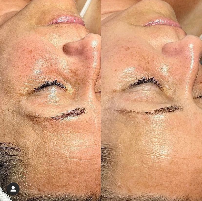 Instagram post by Dr. Fereydoon S. Mahjouri: Before and after #hydrafacial HELLO GLOW Photo: southphillyestie