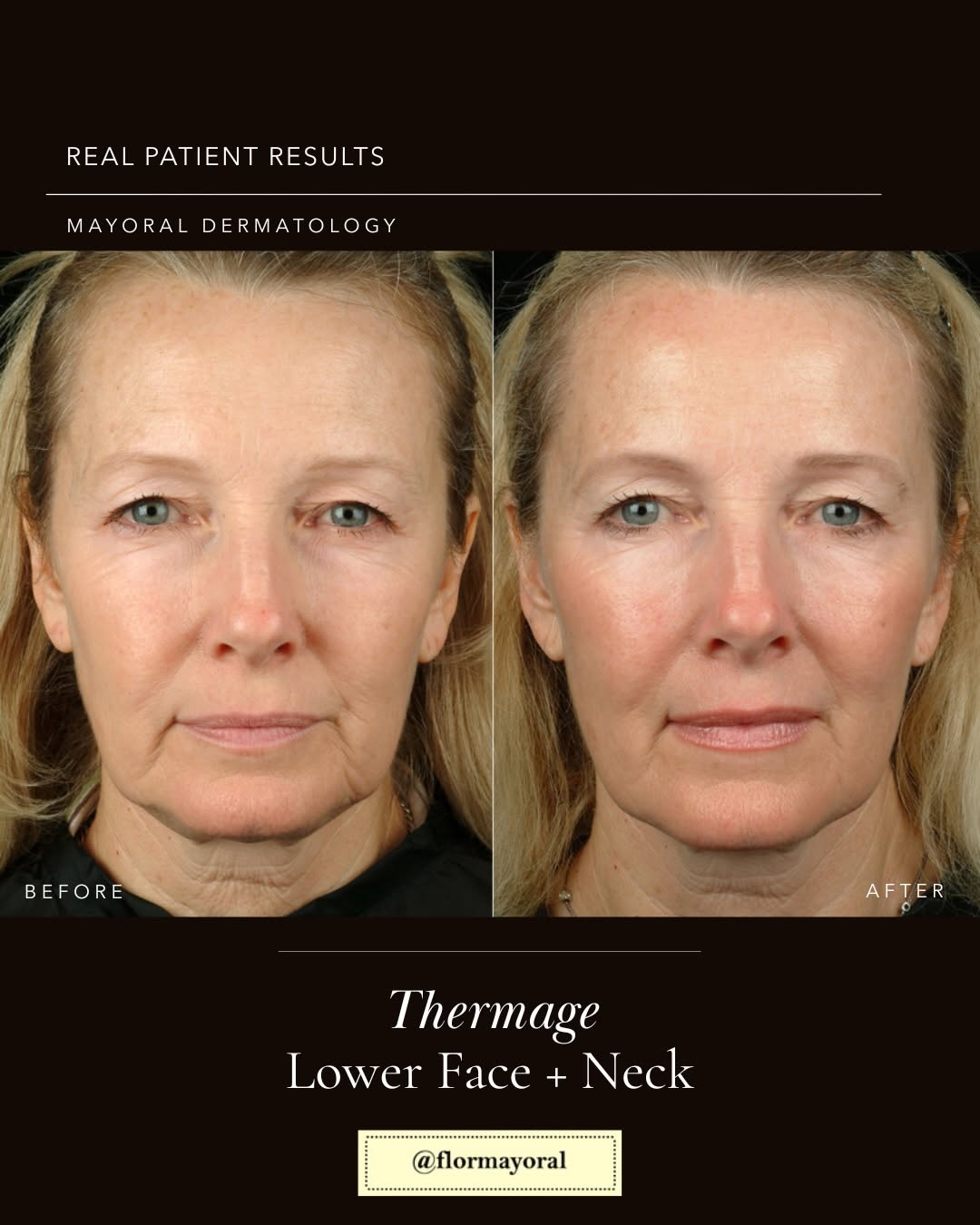 Instagram post by Dr. Flor A. Mayoral: Six months later, the difference is already visible. This patient was treated with Thermage® on the lower face and neck, targeting the area …