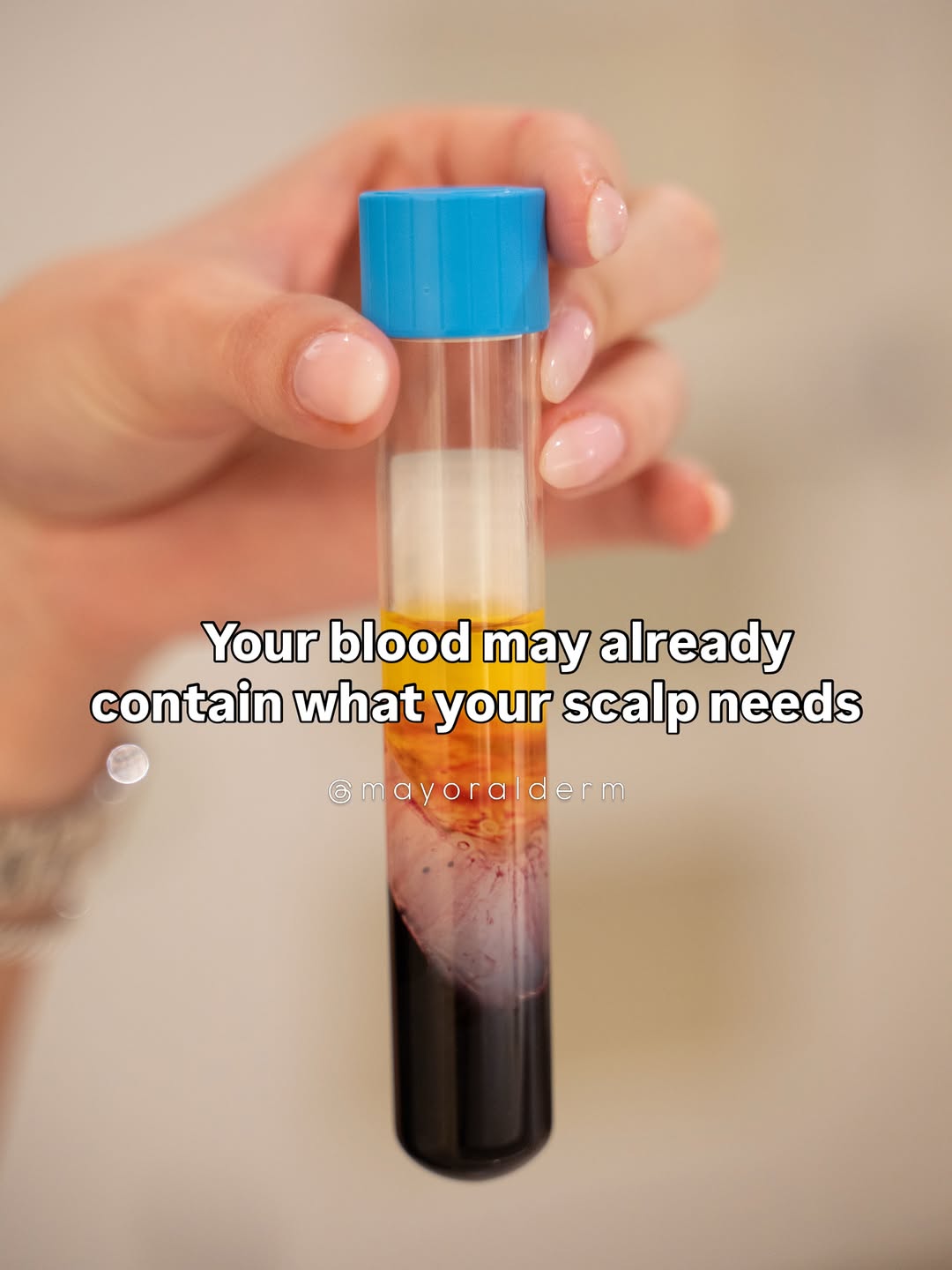 Instagram post by Dr. Flor A. Mayoral: PRP (Platelet-Rich Plasma) starts with a simple blood draw. Your blood is then processed to isolate the platelet rich plasma, which is caref…