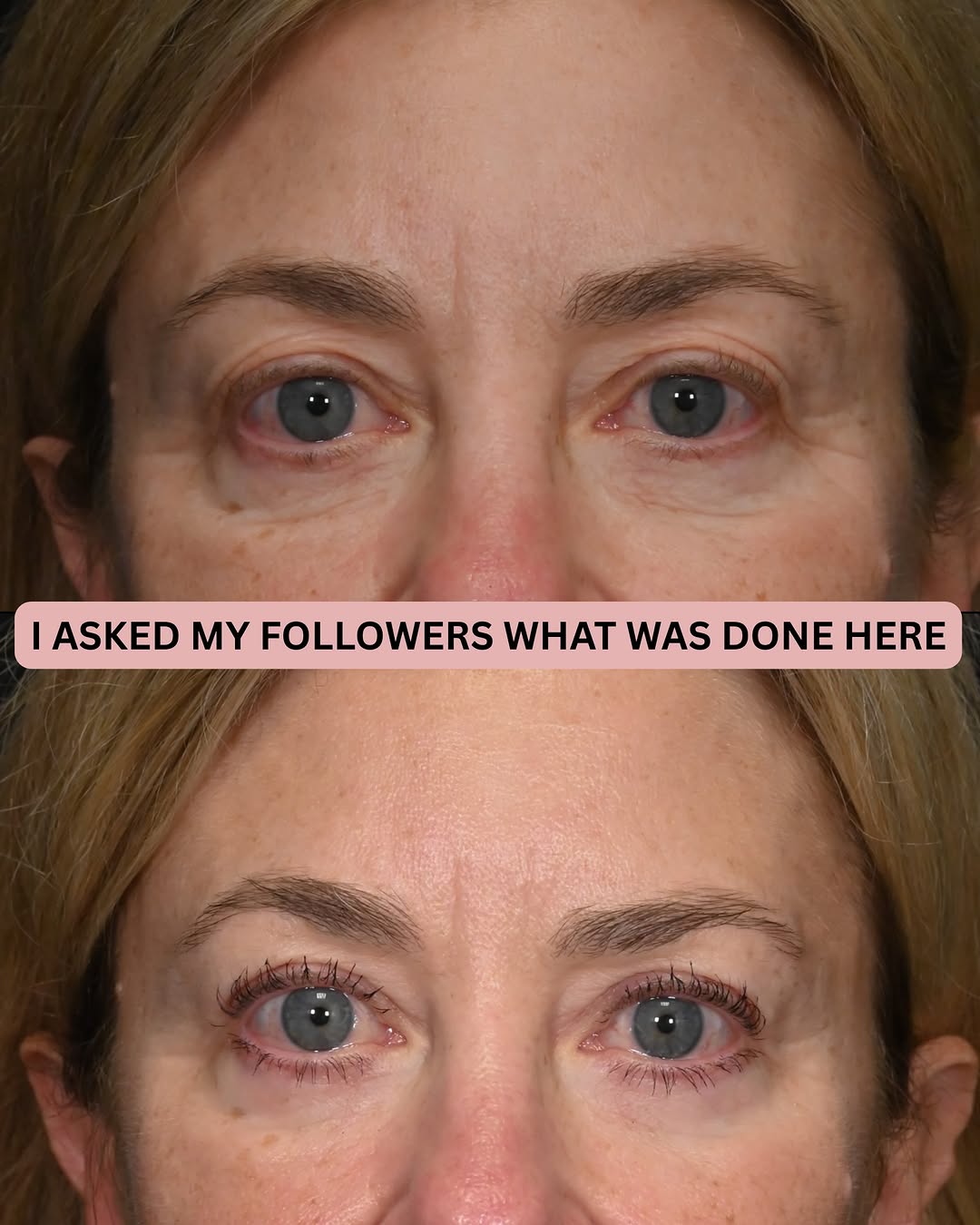 Instagram post by Dr. Flora Levin: Surprised by their answers? Many thought she had a lower blepharoplasty and/or skin pinch. Some thought she had a browlift. It’s so interest…