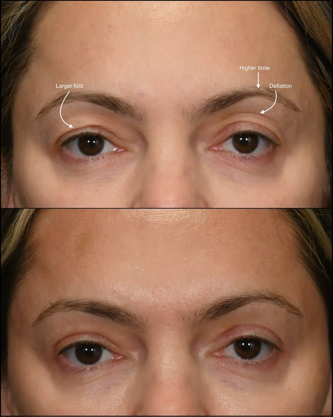 Instagram post by Dr. Flora Levin: 3 factors contributing to asymmetrical eyelids 2 out of 3 corrected: upper blepharoplasty right upper lid Upper blepharoplasty and volume re…