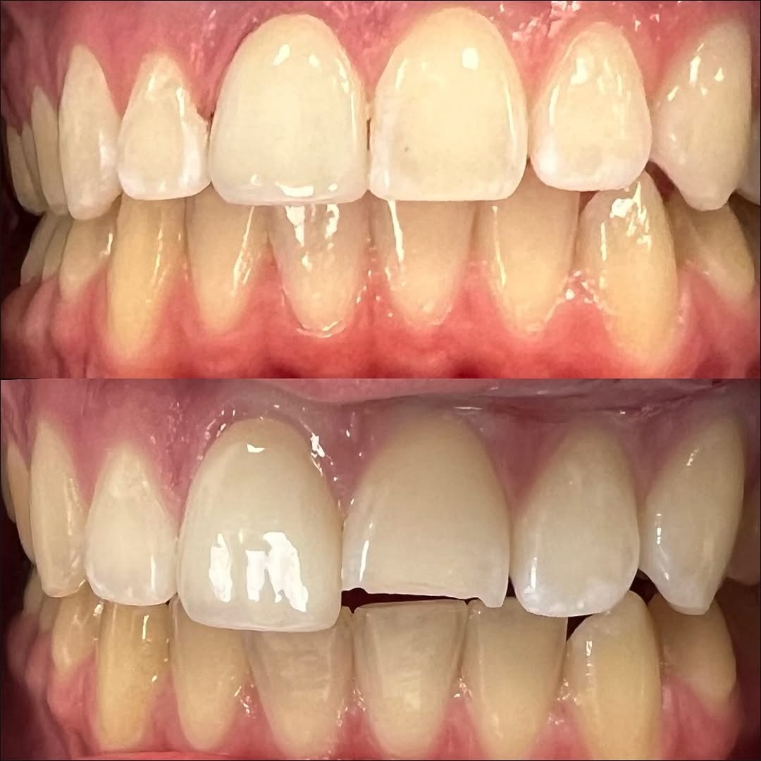 Instagram post by Dr. Forrest 'Scott' Dixon, DDS: Do you have any broken teeth? Chipped and broken teeth can cause major issues! Not only can fractured teeth affect your smile, but can lead …