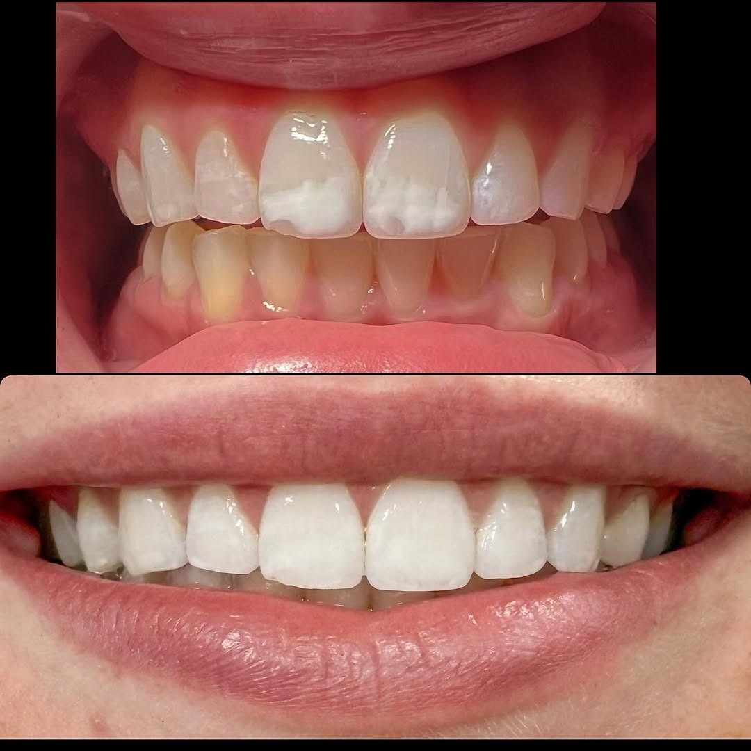 Instagram post by Dr. Forrest 'Scott' Dixon, DDS: Have you ever noticed white spots, brown spots, or superficial stains caused by conditions like fluorosis, demineralization, or early enamel…