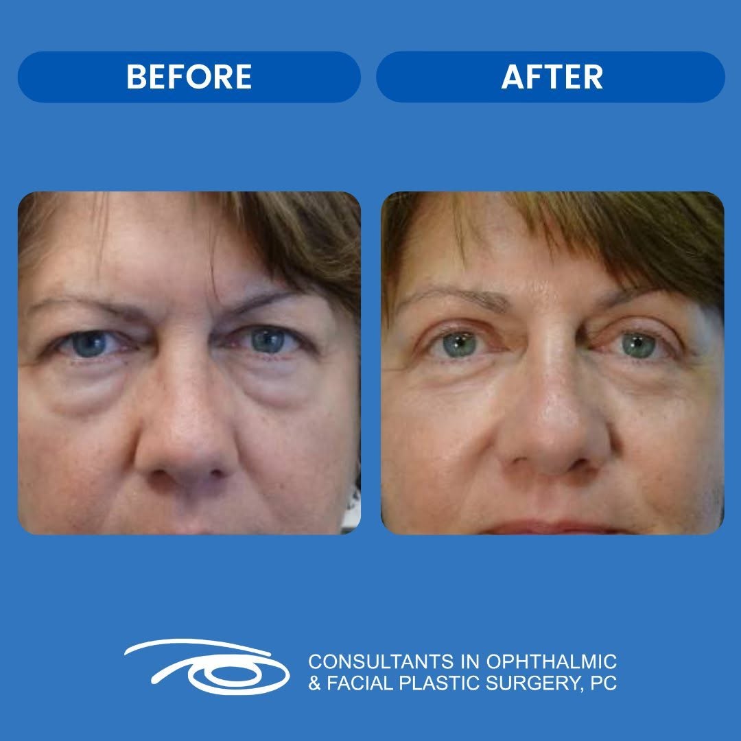 Instagram post by Dr. Francesca Nesi-Eloff: Take a look at before and after a Lower Eyelid Blepharoplasty performed by Dr. Evan Black! 📞 Call us at (248) 357-5100 or visit Eyelidpros.…