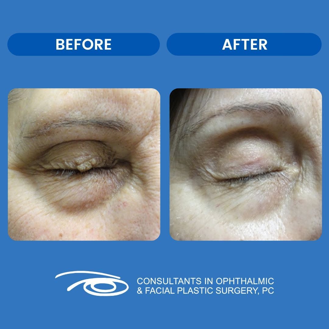 Instagram post by Dr. Francesca Nesi-Eloff: Before and after an Eyelid Lesion removal by Dr. Beaulieu on a patient. Some eyelid lesions can go away on their own and require no treatmen…