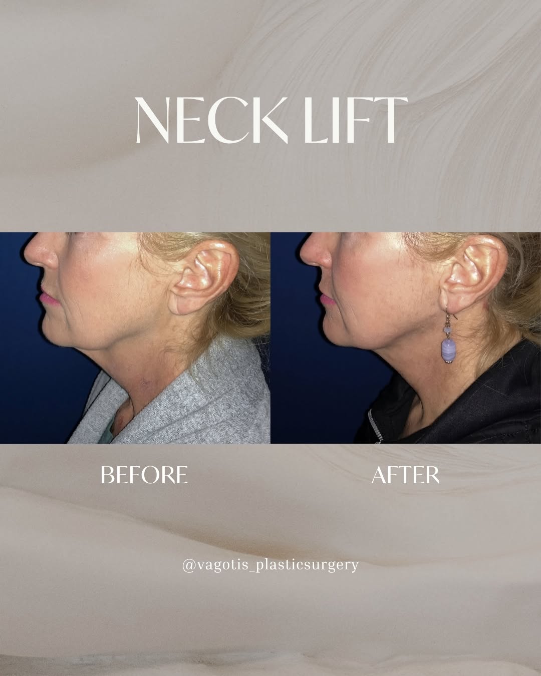 Instagram post by Dr. Francine Vagotis: A defined jawline isn't just about the face. As we age, changes in the neck can affect the entire profile. For this 52-year-old patient, a n…