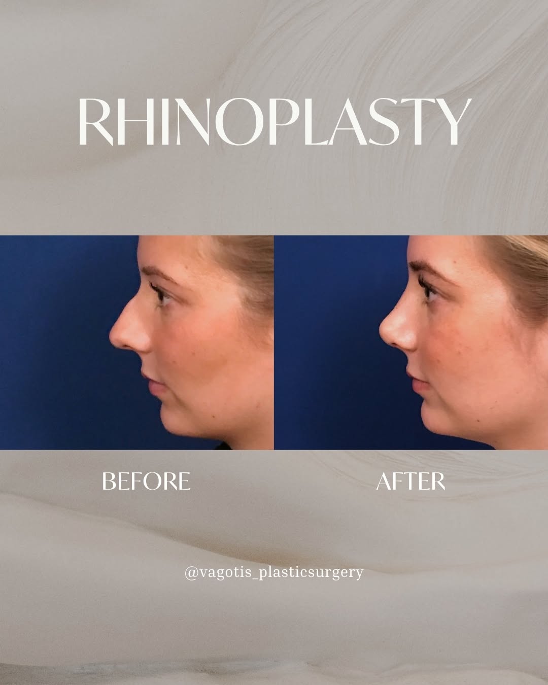 Instagram post by Dr. Francine Vagotis: When a patient tells me they want rhinoplasty, one of my first questions is: What is it about your nose that you'd like to change? Sometimes…