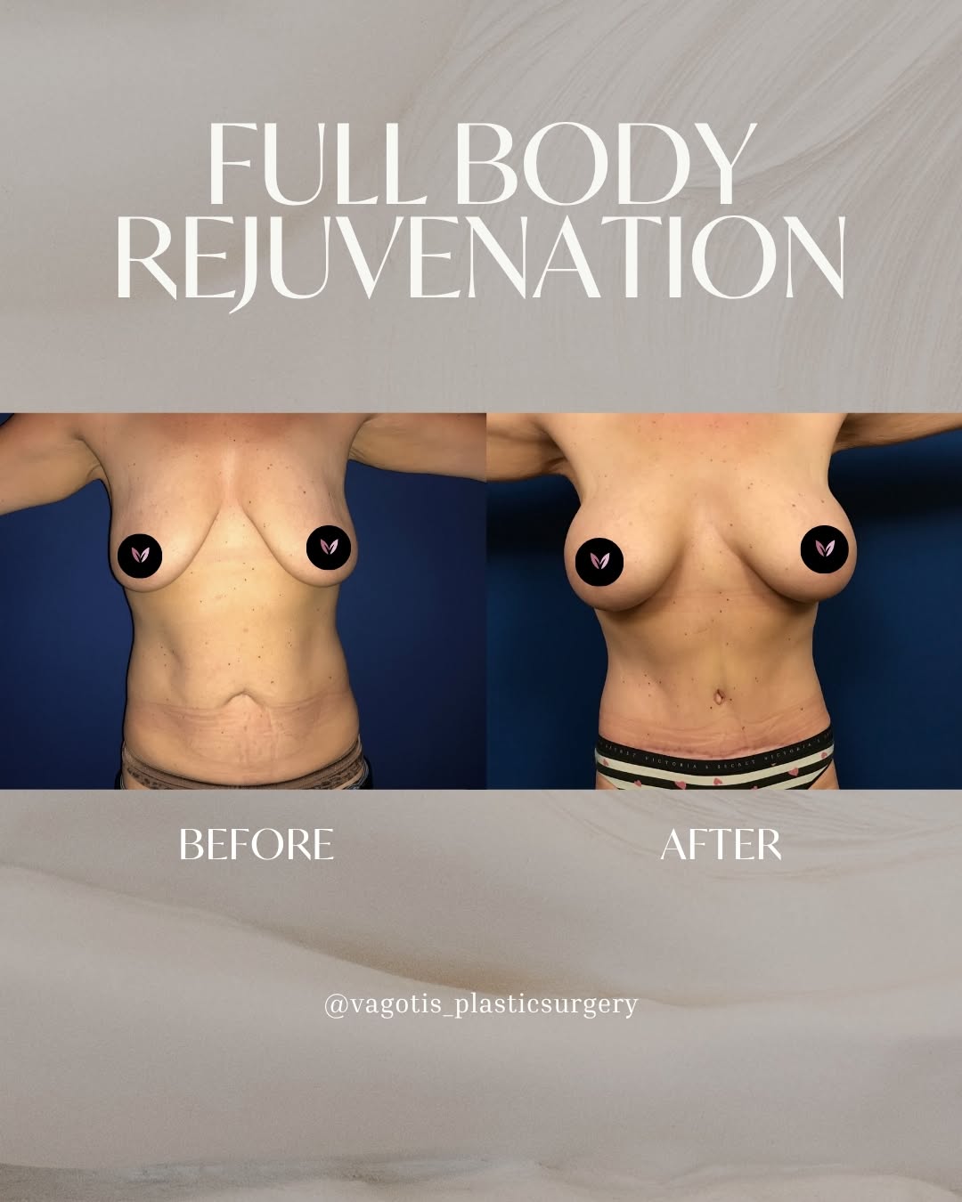 Instagram post by Dr. Francine Vagotis: Full body rejuvenation can mean something different for everyone, but for this patient, it meant addressing both the abdomen and breasts tog…