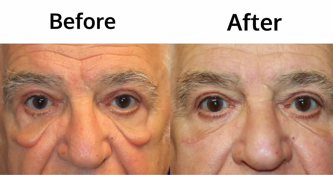 Instagram post by Dr. Francis J. Collini: The Power of a Lower Blepharoplasty Transformation ✨ This lower bleph (eyelid surgery) helped restore a brighter, more refreshed appearance …