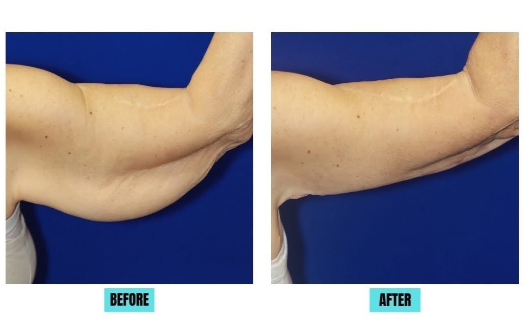 Instagram post by Dr. Francis J. Collini: ✨ Real Results. Renewed Confidence. ✨ This before & after showcases the results of an arm lift (brachioplasty), helping create a smoother, t…