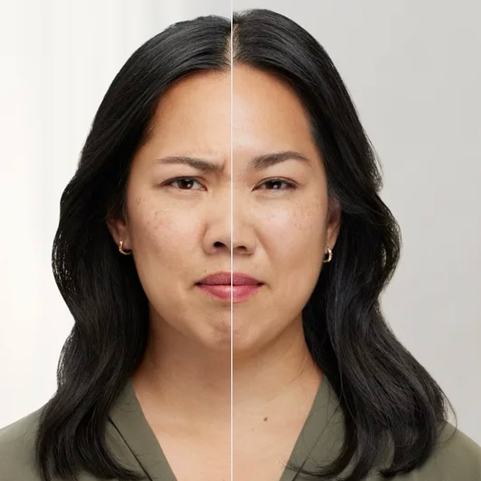 Instagram post by Dr. Frank J. Ferraro: 🔗 Link in story ✨ Glow Up with Our Exclusive Botox Discount! ✨ Ready to turn back the clock and reveal smoother, younger-looking skin? For …