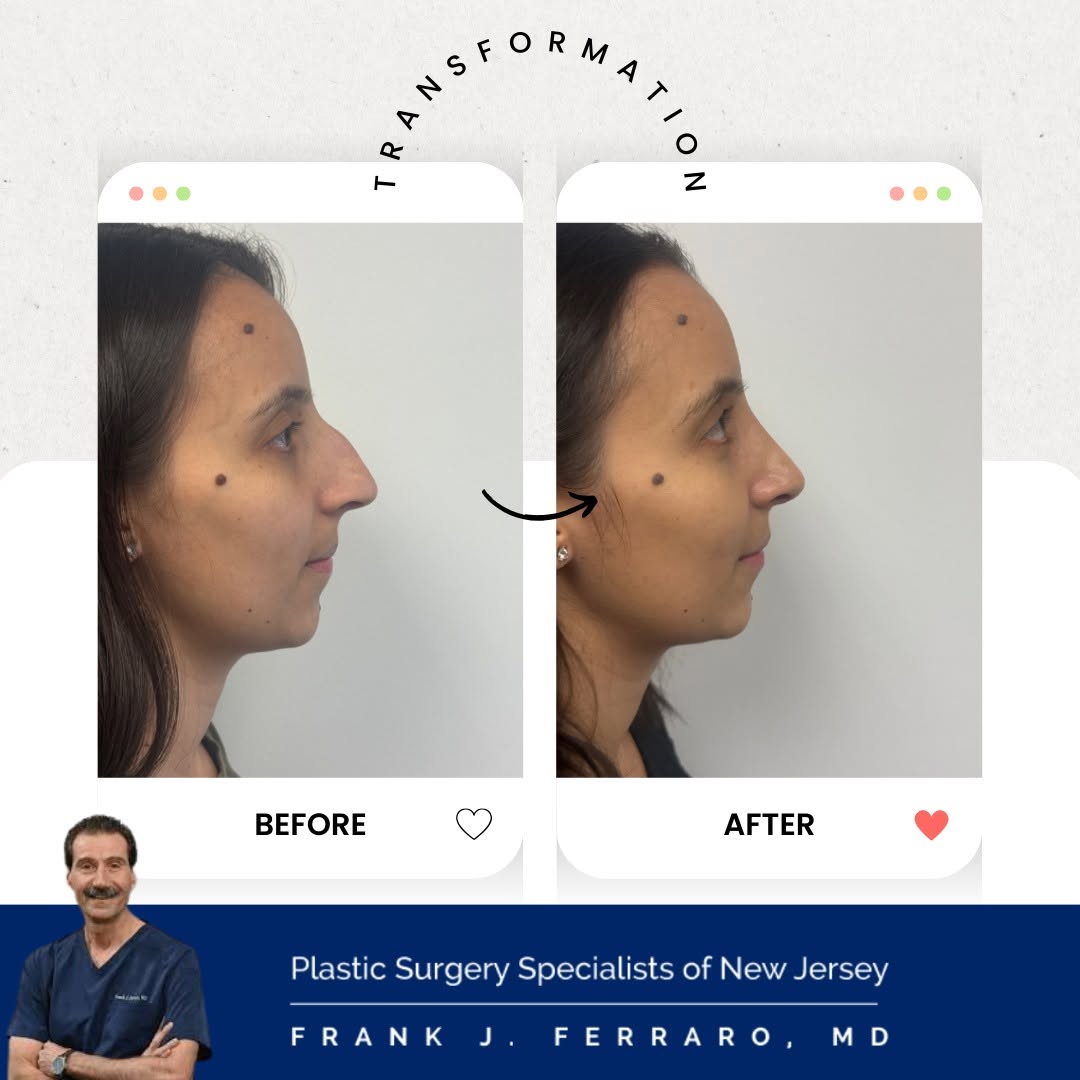 Instagram post by Dr. Frank J. Ferraro: Crafting natural, balanced rhinoplasty results — customized for each patient’s unique features. Performed by Dr. Frank J. Ferraro, MD, FACS …