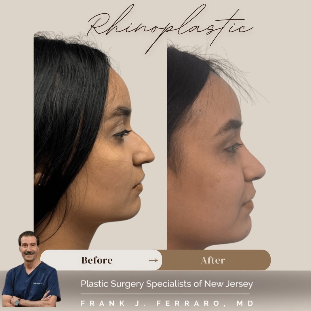 Instagram post by Dr. Frank J. Ferraro: Another set of beautiful, natural rhinoplasty results — designed to complement each patient’s unique features. Expertly performed by Dr. Fra…