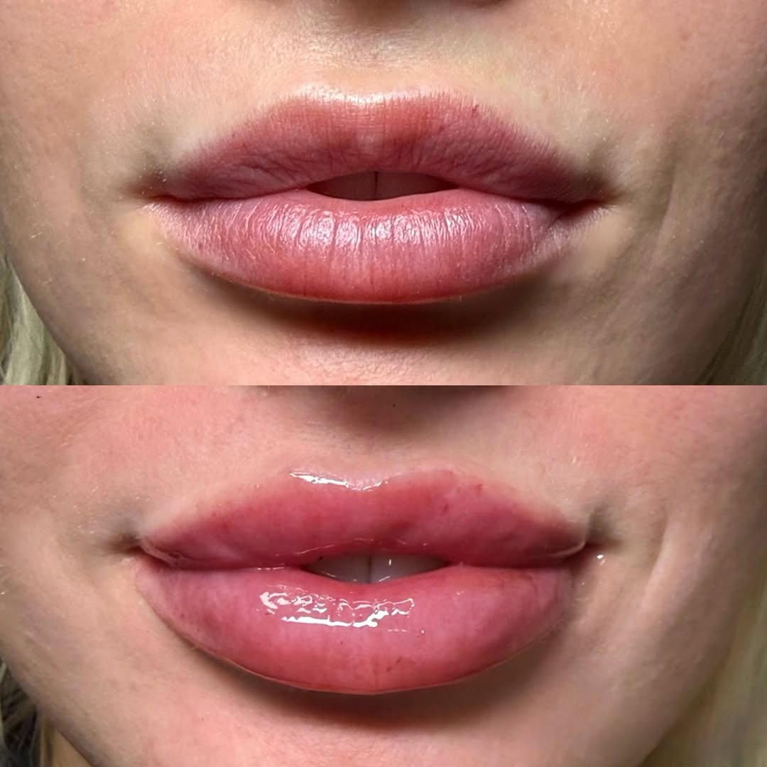 Instagram post by Dr. Frank P. Fechner: A little lip refresh, a lot of confidence. 💋 Beautiful, balanced volume that enhances your natural shape. Lip Filler Fridays are here all S…